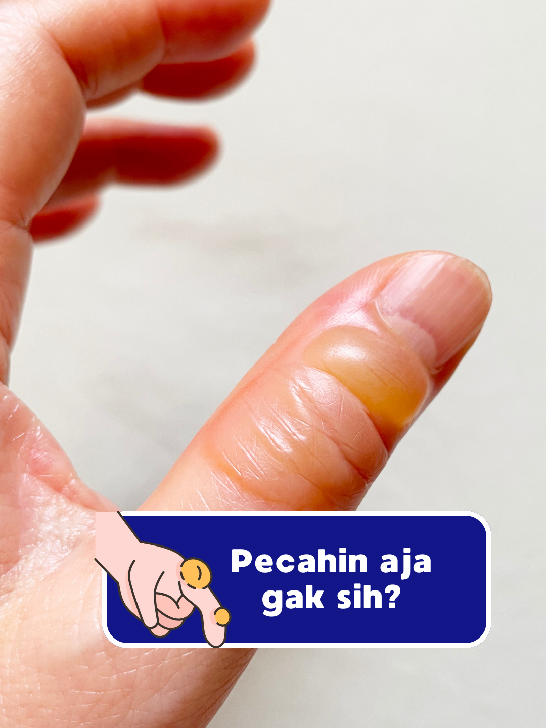 Lepuhan habis luka bakar? Jangan asal pencet, ya! Ini beberapa tips rawat blister di rumah biar gak makin parah: ✅ Cuci tangan dulu sebelum pegang luka ✅ Jaga lepuhan tetap bersih dan kering ✅ Pakai balutan yang gak nempel ke kulit ✅ Jangan digesek atau ditekan ✅ Cek tiap hari, ada perubahan nggak? 🆘 Tapi kalau lepuhannya makin gede, sakit banget, atau sampai keluar bau/nanah — jangan tunda ke klinik luka ya! Ingat… karena luka juga butuh yang tepat 💙 #solusiluka #tipsluka #rawatluka #lukabakar #cairanlukabakar#lukamelepuh #blister