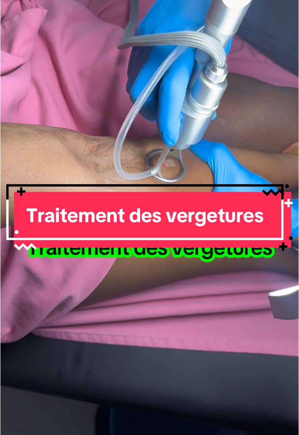 Traitement des vergetures#congo #goma #pourtoipage #kinshasa🇨🇩 #vergetures #sourcils #vergetures #Aprèssionvisage #Nos #masser #beaute #soinvisage #rwandatiktok🇷🇼 #rwanda #congo #