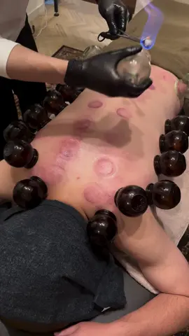 ##asmr #masaj #cupping 