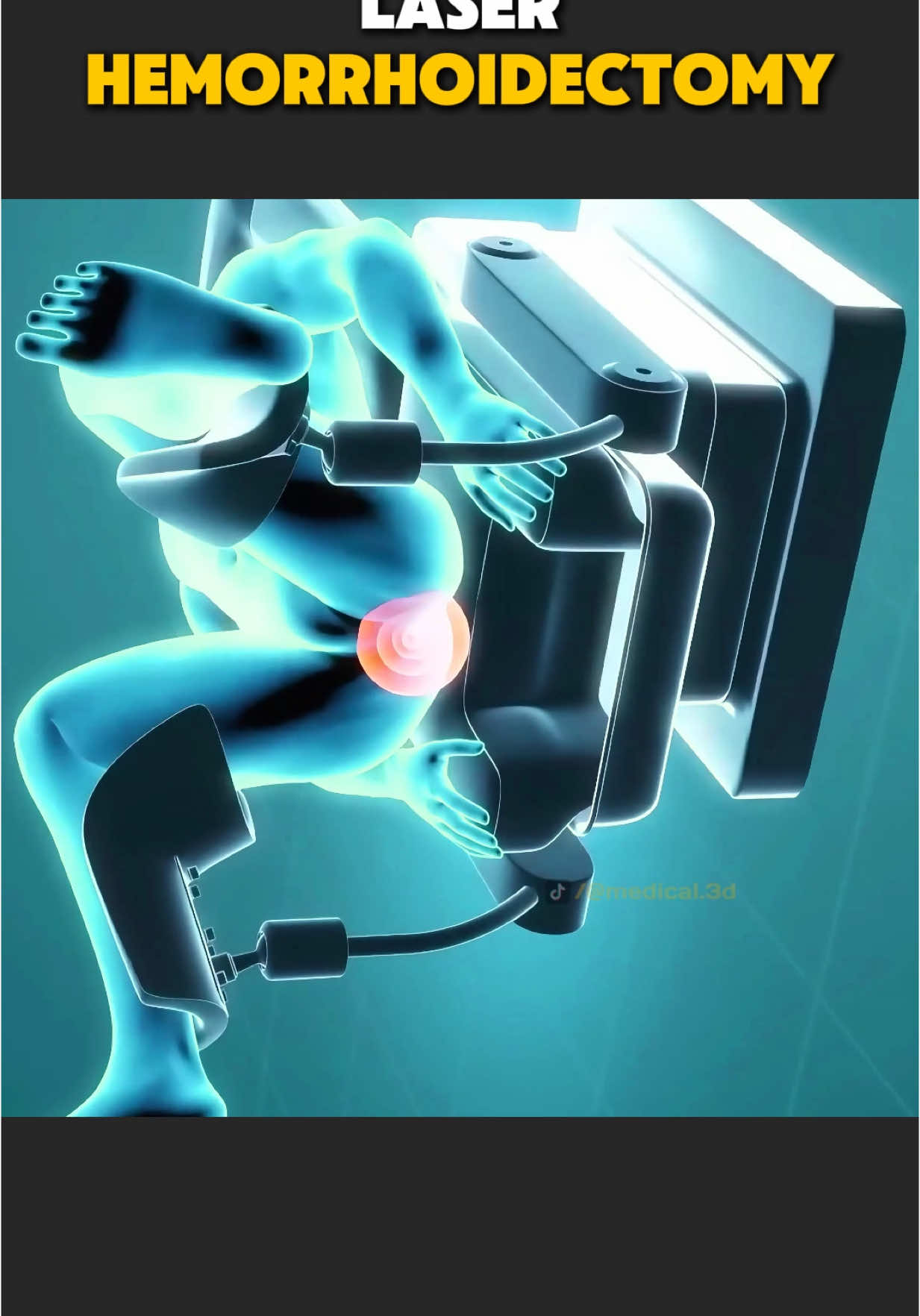 Laser Hemorrhoidectomy Procedure (3D Animation) #hemorrhoids #hemorrhoid #hemorrhoidectomy #hemorrhoidsurgery #hemorrhoidssuck #hemorrhoidrelief #piles #pilestreatment #laserhemorrhoidoplasty #medical3danimation #3dmedicalanimation 
