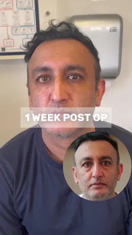 Is lower eyelid surgery painful? Dr Kalpesh shares his experience one week on... One of the most common questions we get is about recovery after lower eyelid blepharoplasty. While every healing journey is unique, Dr Kalpesh @voguedentalcare had a smooth experience, no post-op pain and a great early result. In this video, he shares how the first week has been and what helped make his recovery so straightforward. #LowerEyelidSurgery #BlepharoplastyRecovery #TransconjunctivalBlepharoplasty #HealingJourney #OculoplasticSurgery #UnderEyeRejuvenation #PatientExperience #NaturalResults #EyelidSurgery #BlepharoplastyLondon