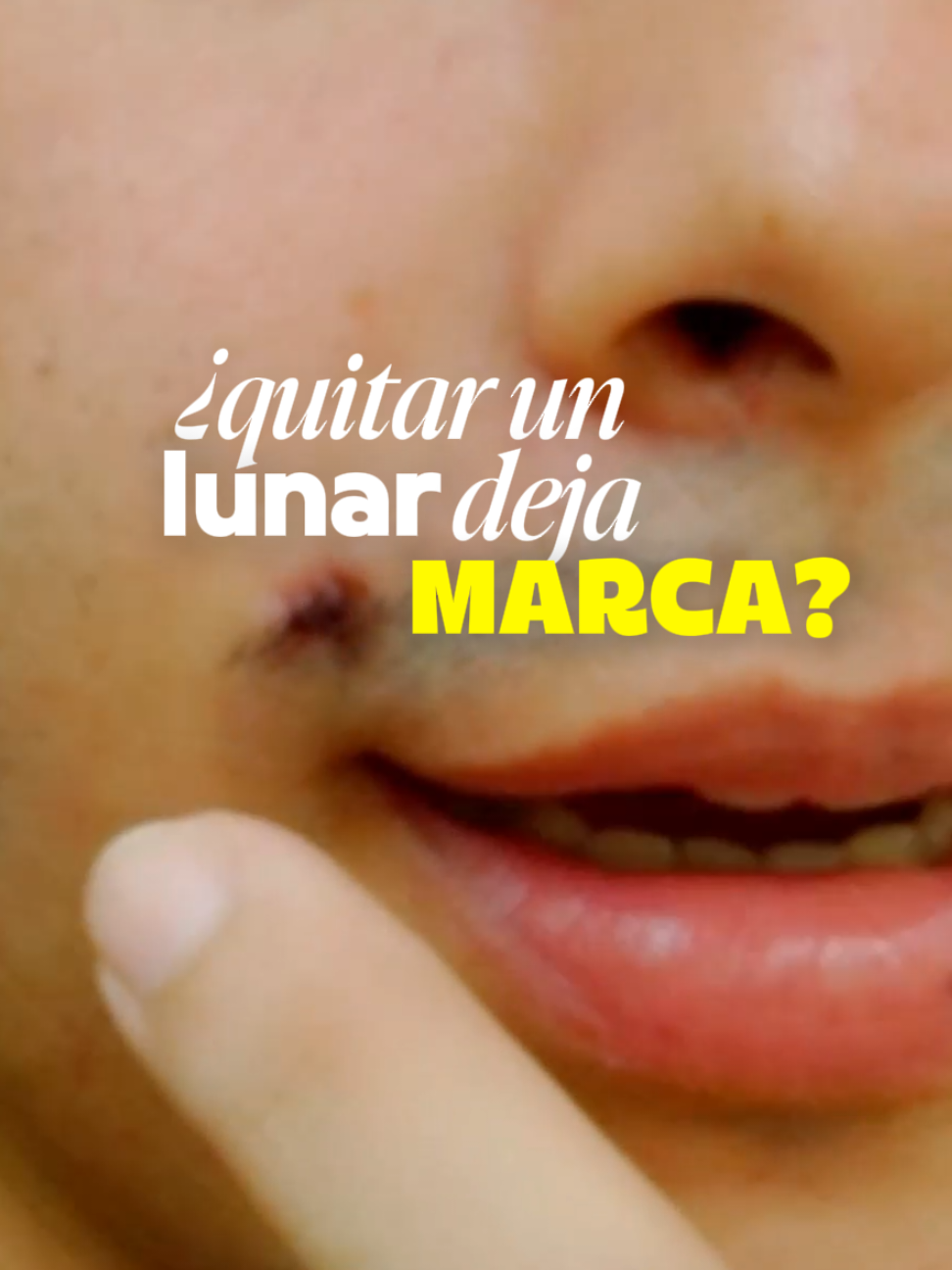 (publi) Me dolió solo la anestesia, de resto too' chill gracias a la @Dra Lorena Quiroz por ayudarme en este proceso. #eliminarlunar #cauterizaciondelunares #storytime 