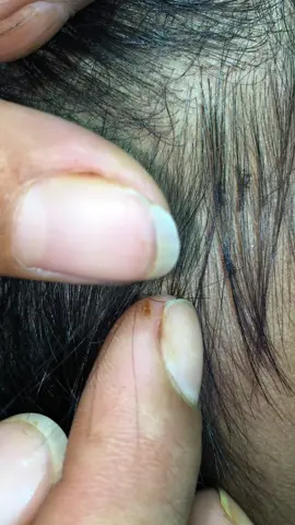 Giant lice #😂😂😂 #😱😱😱omg #😍😍😍 #tripofobia #😭😭😭 #liceRemoval #🤮🤮🤮 #lice #😨😰🥶 