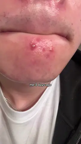 lion pair> #acne #acnecream #lionpairacnecream #lionpaircream #tiktokshop #discount #pimples #acnescars #skincare #zits #zit #tiktokshopcreatorpicks #acneremoval #ttscreatorbash  #tiktokshopsummerturnup 