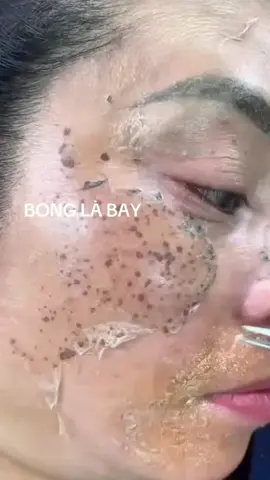 Nay nám bay tàn nhang #congchamda #foryou #xuhuong #nám_tàn_nhang_mụn_thâm_trắng_da #Munnamtannhang #chamtannhang #peelda #fyp #beauty 
