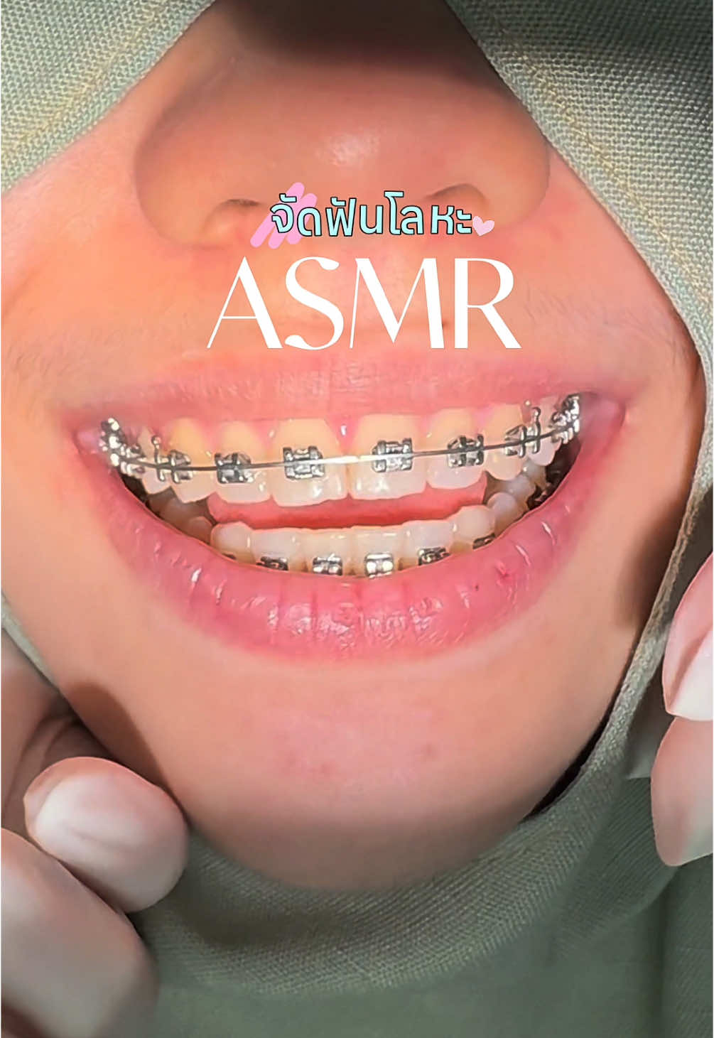 #asmr เปลี่ยนสียางจัดฟันกัน😍  #เชนจัดฟัน  #จัดฟัน  #จัดฟันเปลี่ยนชีวิต  #จัดฟันครั้งแรก  #หมอฟันtiktok  #เบทเทอร์สไมล์ภูเก็ต  