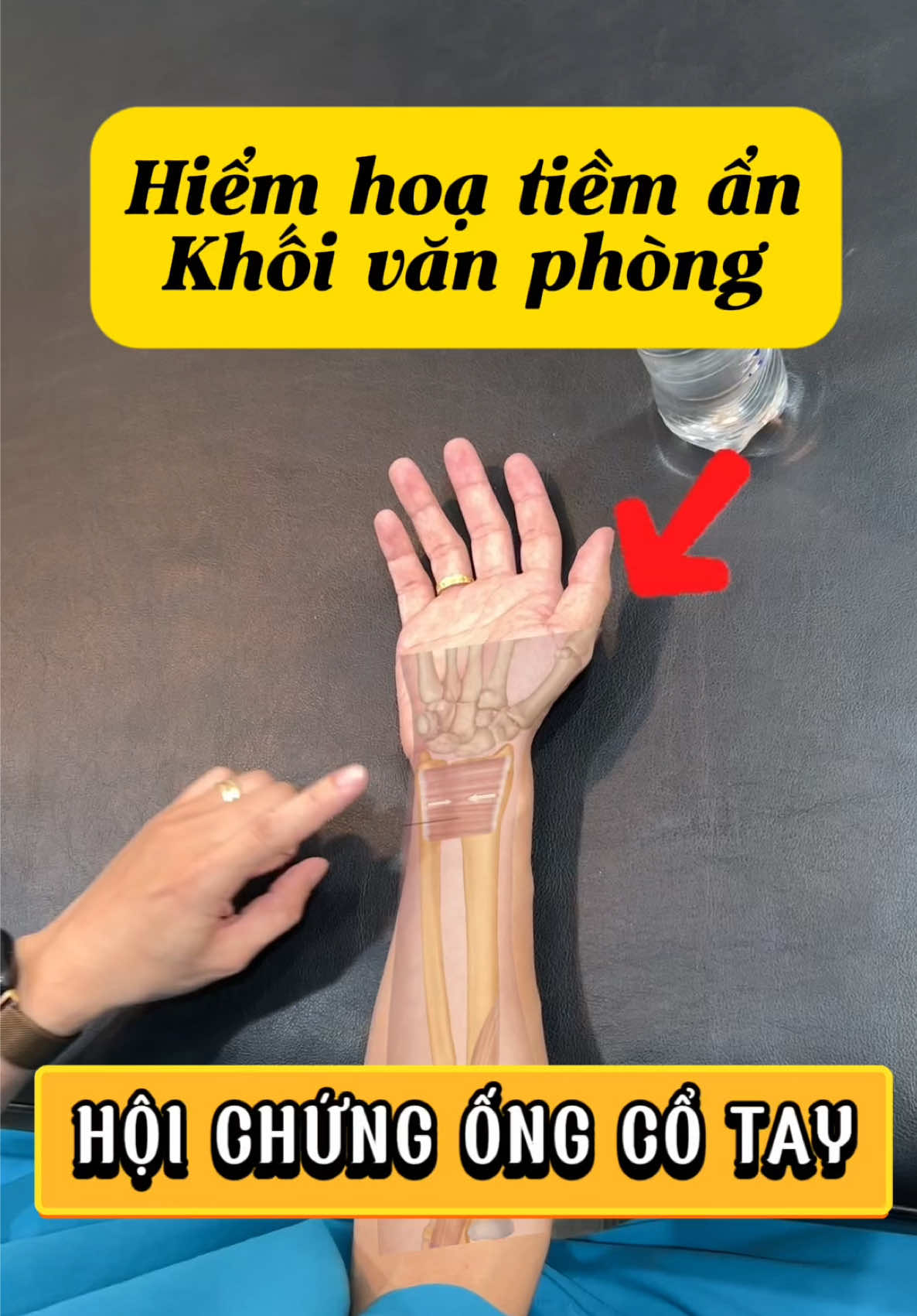 💪 Giảm đau – Tăng linh hoạt Bài tập đơn giản giúp cải thiện hội chứng ống cổ tay, giảm tê buốt và tăng sức mạnh cho cổ tay. Tập đều đặn mỗi ngày để cảm nhận sự khác biệt! ✨ #HoiChungOngCoTay #GiamDauCoTay #Chamsocsuckhoe  #BaiTapTaiNha #phongkhamcoxuongkhop #phongkhamcoxuongkhophcm 