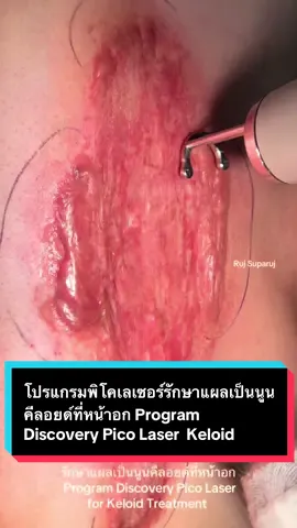 เทคนิคการใช้โปรแกรมพิโคเลเซอร์รักษาแผลเป็นนูนคีลอยด์ที่หน้าอก Program Discovery Pico Laser for Keloid Treatment  #รักษาแผลเป็น #รักษาคีลอยด์ #แผลเป็น #เลเซอร์แผลเป็น โปรแกรม #discoverypicolaser โปรแกรม #discoverypicosecondlaser #fractionalco2laser #drsuparuj #demedclinic #หมอรุจชวนคุย  @Ruj Suparuj 
