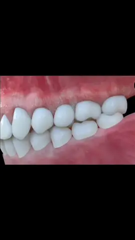خلع الضرس تركيب الاسنان تعويض الضروس المخلوعه بزراعة وتقويم الاسنان #dentist #dentalstudent #teethwhitening #teethcleaning #foryoupage #foryou #fyppppppppppppppppppppppp #fupシforyou 