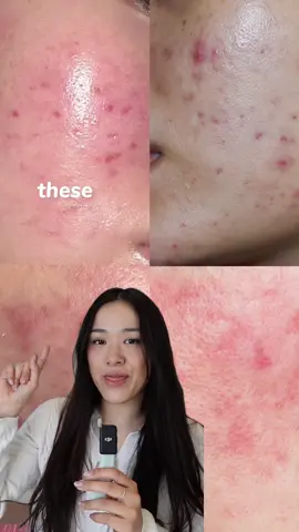 Think you’re treating acne scars? 👀 You might actually be dealing with PIE or PIH—two very different things. Same breakout, different aftermath. 🔴 PIE = red marks 🟤 PIH = brown spots Treat them right 👉 Watch the reel & comment 