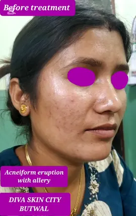 #creatorsearchinsights#divaskincitybutwal #skinandlaserclinicbutwal #dermatologistbutwal #melasmaandacnetreatment #glowingskinbutwal #healthyskinbutwal @Diva Skin City @DermaTalk.com @SKIN STORE PVT LTD 