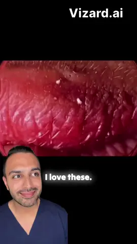 Blackheads got you down? Let's break it down! 🤔✨ Dive into the fascinating world of comedone extraction, where we tackle those pesky open and closed comedones that love to pop up around your smile zone. 😄 Did you know that excess sebum and keratin can lead to these little troublemakers? Not to worry! With the right techniques, like gentle extractions and targeted treatments, you can banish those blackheads for good! Discover the importance of salicylic acid washes and the magic of AHAs and BHAs in your skincare routine, plus how retinols can transform your nighttime regimen. 🌙✨ Join the journey to clearer skin and learn tips that will leave your perioral area looking fresh and fabulous. 💁‍♀️💖 #BlackheadRemoval #SkincareTips #ComedoneExtraction #PoreCleaning #DrSomji #SkincareRoutine #HealthySkin #BeautyHacks #GlowUp #SkincareCommunity #AcneSolutions #RadiantSkin