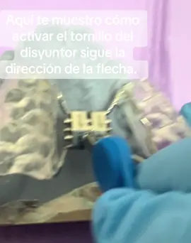 ¿Cómo activar un disyuntor?  . Tener la llave que corresponde al disyuntor.  . Colocar la llave en el agujero del tornillo que esté en la base de la flecha.  . Desplazar ese agujero en dirección a la punta de la flecha.  . Seguir las indicaciones del ortodoncista si es una vuelta entera, 1/2, 1/4, la que corresponda al protocolo de ese caso.  . Sacar la llave cuidadosamente.  . Así repetirlo.  . Apuntar fecha, hora y cuánto de vuelta al tornillo le ha dado.  Te espero en consulta.  #ortodoncista #disyuntor #disyuntorpalatino #ortopedia #ortopediainfantil #ortopediamaxilar #ortodonciamadrid #parati #foryou #pourtoi #paravoce #dientes #odontologiainfantil #ortodonciainfantil #madrid #españa 