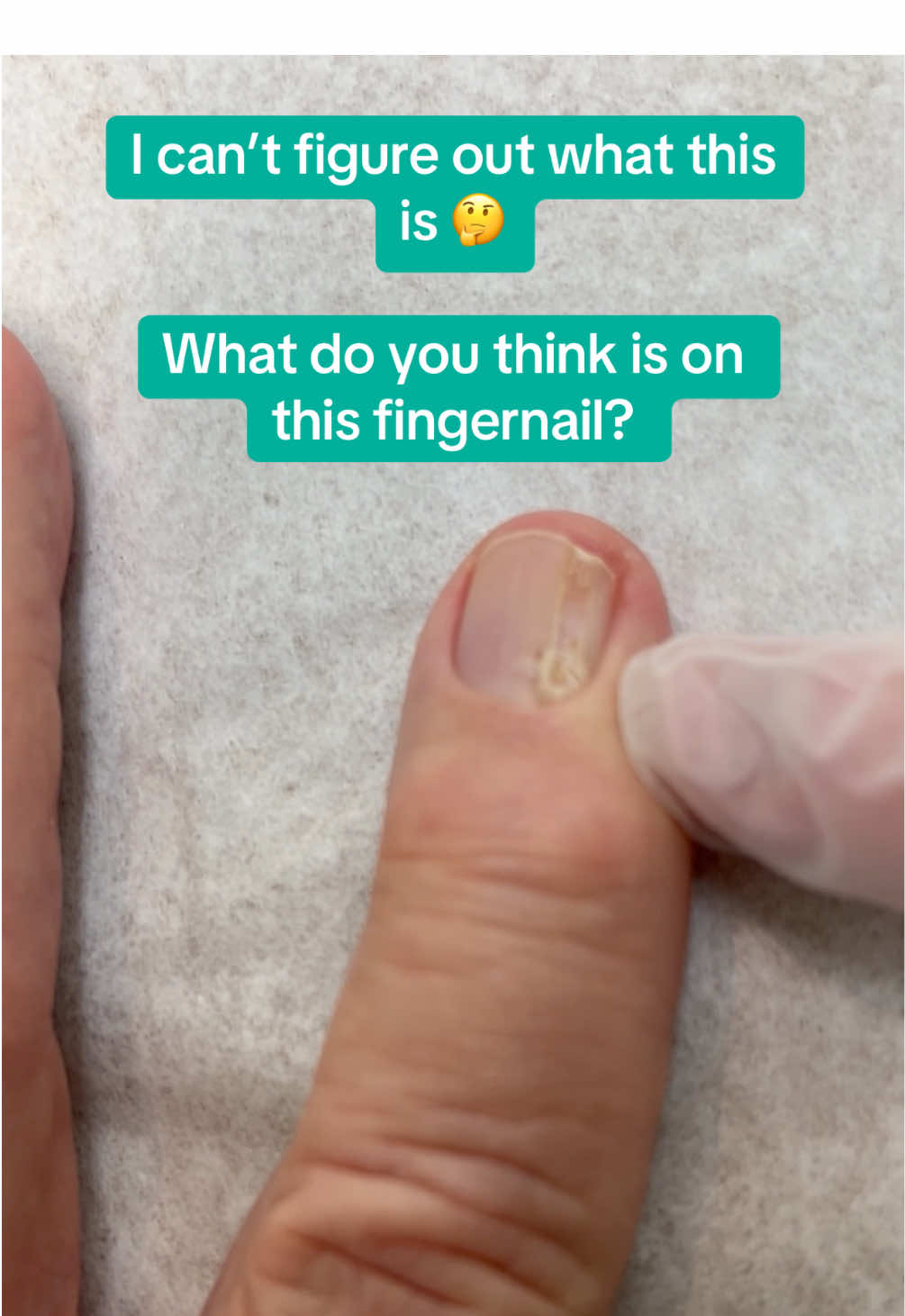 Tell us what you think this is while we await the biopsy results!  ##fellowship##dermatologist##dermatology##fyp##explorepage##learn##skincare##doctor##practice##fingernail##biopsy