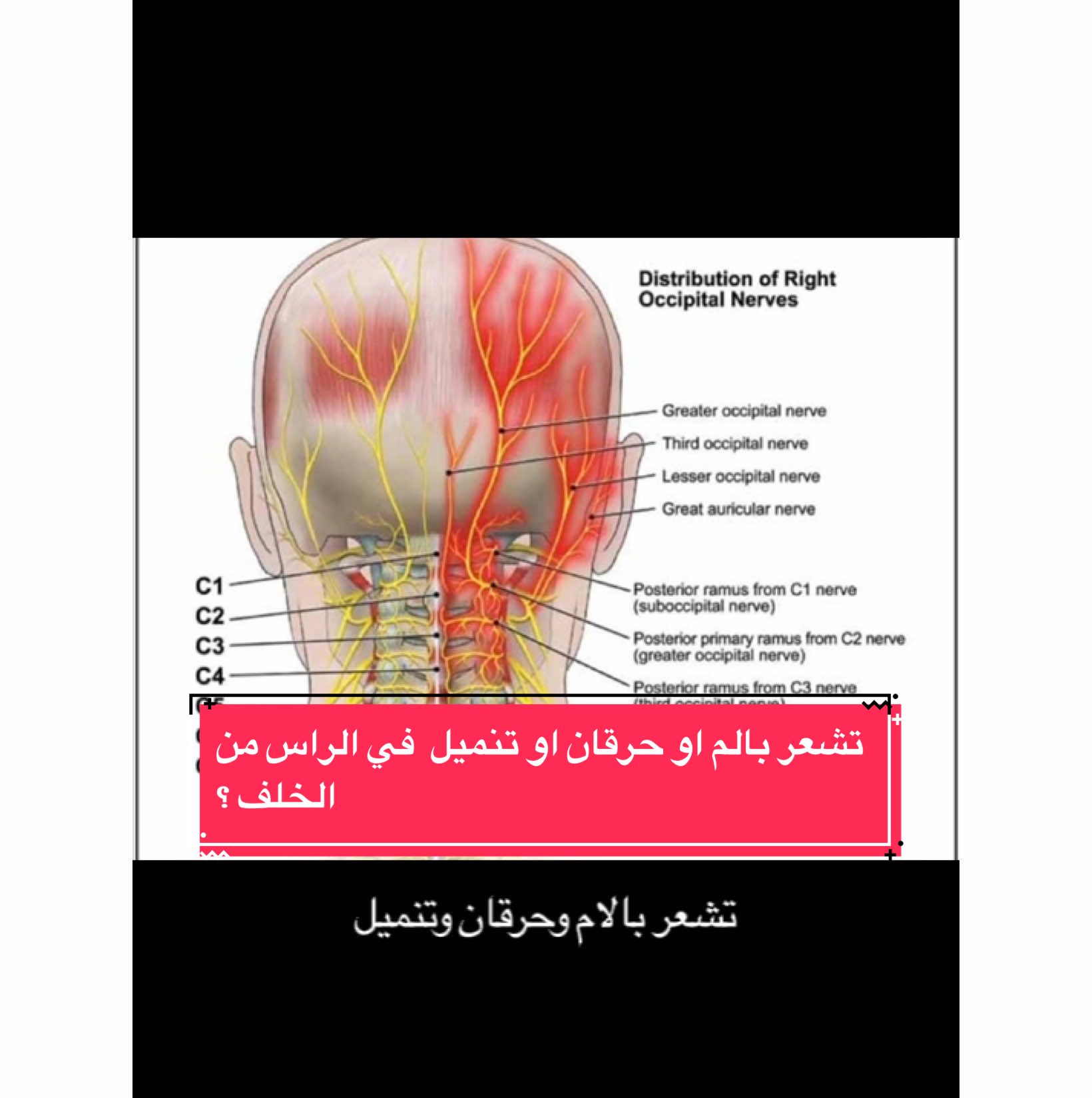 تحتاج فحص دقيق جدا  #العصب_القذالي #انضغاط_وتهيج_العصب_القذالي #حرقان #تنميل #الم_خلف_الراس 