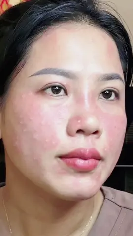 🌻Hành trình peel da ngày thứ nhất #Elybeauty #xh 