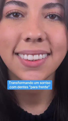 Transformando um sorriso com dentes “para frente” #dentistry #dentistryworld #dentistrylife #odontology #dentista #odontologia #dentistica #dentistasp #dentista #vidadedentista #dentisticarestauradora #restauracaodentaria #lentesemresina #facetasemresina