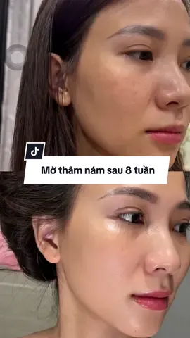 Cách bạn hỏi mình nhiều về tip giảm nám, thì đây là cách mình dưỡng sáng và mờ thâm nám sau 8 tuần với em serum Melasyl hồng dưỡng sáng của nhà L’Oreal Paris này #chihovlog #muataitiktokshop #serummelasylhong #glucolicmelasyl #lorealparis #lorealparispartner #lorealparisskincare 