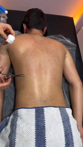 ohhh hot cupping Alinezhad😱😍 . . . . . . . . . . . . . . #asmr  #cupping  #asmrslime  #asmreating  #asmrsounds  #asmrvideo  #fire  #explore  #reels  #viral  #blood  #pizza  #fypage  #fyp  #explorepage✨  #keşfet  #dubai  #good  #massageindubai  #hotstonemassage  #sleep 