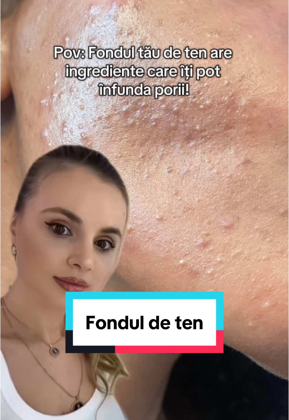 🔬 Știi ce conține fondul tău de ten? Poate fi motivul coșurilor tale! Ingrediente comedogene – acele substanțe din produsele cosmetice care pot bloca porii și pot duce la apariția acneei, punctelor negre și a texturii neuniforme a pielii. 💄 Multe fonduri de ten conțin ingrediente precum: • Isopropyl Myristate • Coconut Oil / Derivați din ulei de cocos • Lanolină • Alcooluri grase (ex: Myristyl Myristate) • Pigmenți grei sau uleiuri minerale occlusive Acestea pot părea inofensive la prima vedere, dar dacă ai un ten gras, mixt sau predispus la acnee, ele pot face mai mult rău decât bine. 😣 #drralucaharnagea #skincare #foundation #acnee #foru 