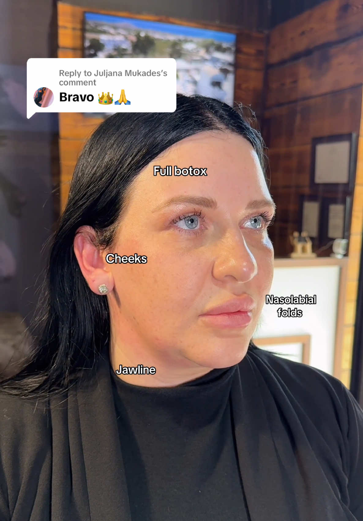 Replying to @Juljana Mukades ❤️ Suksesi eshte te permiresojme pamjen pa u kuptuar cfare kemi bere🗝️ #drfladinezha #drfladi #nclinique #nclinique #tirana #albania #filler #fyp #viral #video 