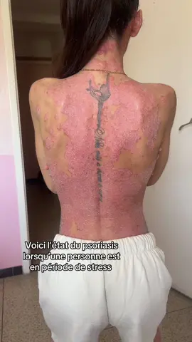 Les plaques sont enflammées #psoriasis 