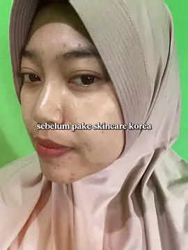 #CapCut ekstra sabar ngilangin bekas jerawat😭 yuk semangattt🙌🥰