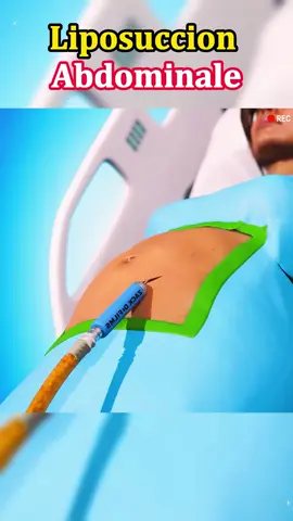 Comment se passe VRAIMENT une lipo ? (Spoiler : c’est moins effrayant que vous pensez) #chirurgieesthétique #liposuccion #transformation #beautéfrance #ventreplat #témoignagemed #conseilbeauté #beforeafter 