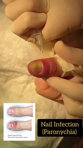 Worried about redness, swelling, or pus around your nails? 🧤 It could be Paronychia — a common but painful nail infection caused by bacteria or fungus. Learn how to identify early signs, prevent it, and treat it safely at home or with professional care. 💅✨ Don't ignore nail pain — it can lead to complications if left untreated! 👨‍⚕️ Expert tips from Dr. Sara Shahid #Paronychia #NailInfection #NailCare #SkinInfection #DermatologyTips #SwollenNail #FungalInfection #BacterialInfection #HealthyHands #DermoDent #DrSaraShahid #LahoreClinic #NailHealth #MedicalReels #Shorts #NailInfectionTreatment #HealthyNails #ParonychiaTreatment #NailInfectionAwareness #AAALASPARATUCURRO 