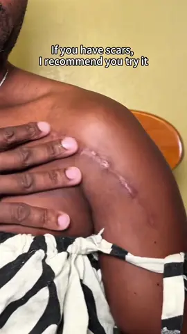 If you have scars this is what you need #scar  #scartape  #skincare  #skincareroutine  #skincaretips  #silicone  #siliconescartape  #fashionlookbook  #Holidayshopping  #Tiktokshopholidayhaul  #Spotlightfinds  #giftsforher  #giftsgorhim  #newyearnewaura  #holidayhaul  #creatorsearchinsights 