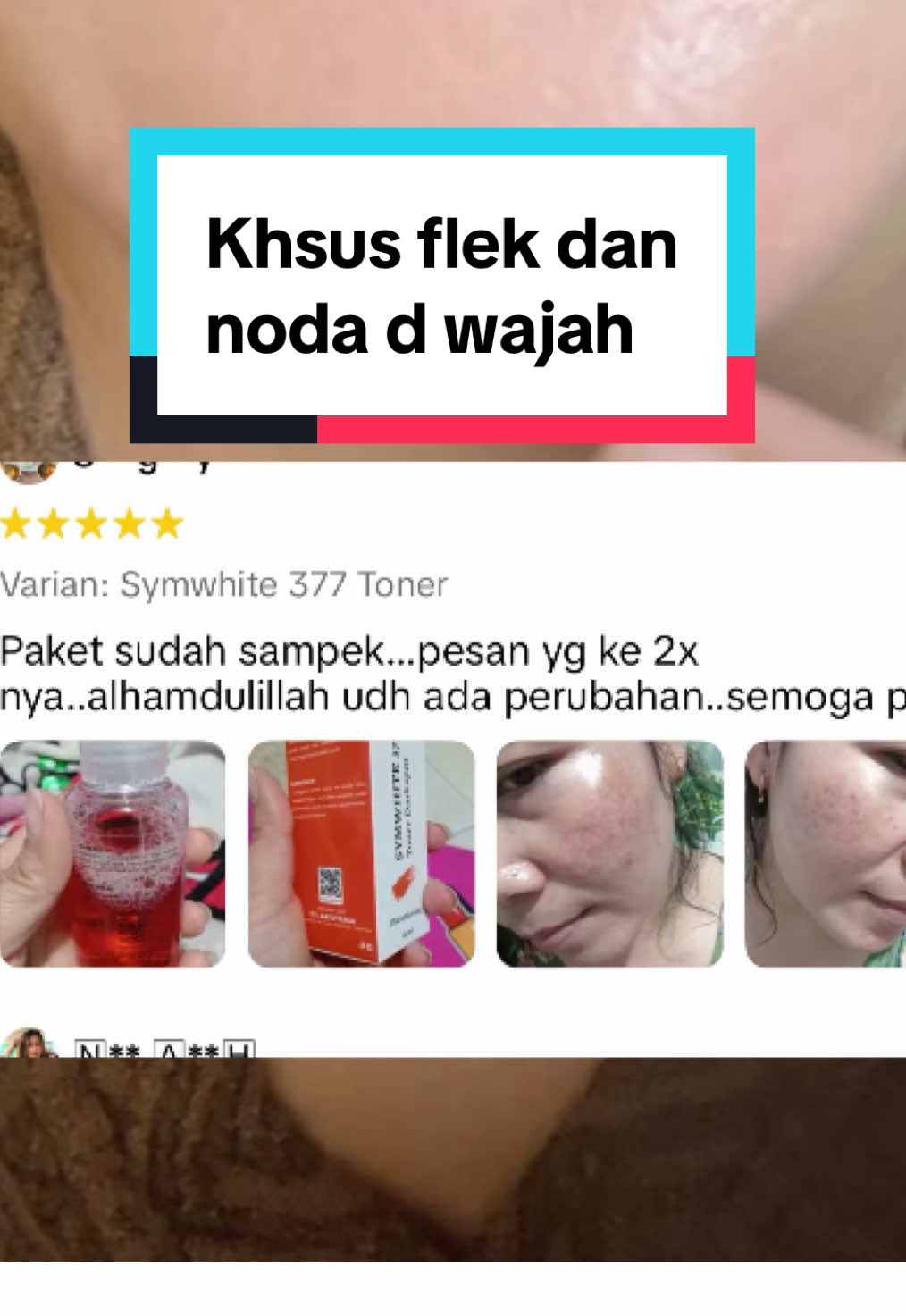 Rekomendasi toner khusus flek dan bekas jerawat yang berkulit kusam dari Yonglow #yonglow #symwhite377 #toner #toneryonglow #tonerflekhitam 