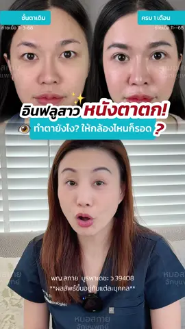 อินฟลูสาว หนังตาตก 😔 ทำตายังไง ให้กล้องไหนก็รอด ‼️ #หมอสกาย #จักษุแพทย์ #หมอตา #รีวิวตาสองชั้น #ชั้นตาหลบใน #skyclinic #สกายคลินิก #ทำตาที่ไหนดี 