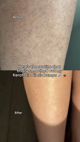 are KP bump ruining your hot girl summer vibe? #strawberryskin #chickenskin #hairremovalroutine #hairremovaltips @dhanjeet_dhillon