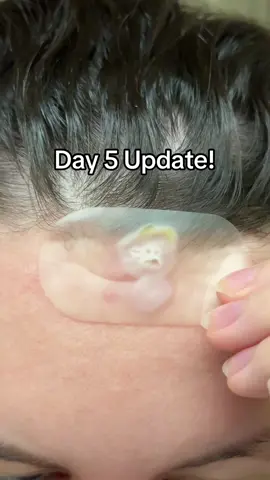 Monday is when we will know for certain what it is! #pimplepopper #acne #cystpopping #satisfying #fyp 