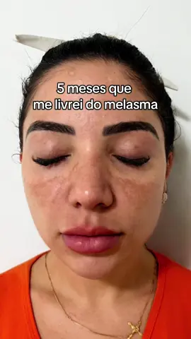 5 meses já do meu antes e depois e a minha pele continua sem manchas. Sei que muitas tem receio com medo de efeito rebote então mostro para vocês como está a minha pele. Não tá uma pele perfeita afinal sou Brasileira e não Coreana, mas sigo satisfeita com clareamento do melasma. #melasma #skincare #manchasnapele #pelesaudavel #pelesemmanchas #dicasdeskincare 