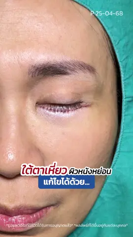 ปัญหา #ถุงใต้ตา หย่อนคล้อย แก้ได้ด้วย..⁉️😲 #กำจัดถุงใต้ตาแผลนอก #babylock #หมอสกาย #skyclinic #ตัดถุงใต้ตา #จักษุแพทย์ #ทำตาที่ไหนดี #ศัลยกรรมตา #สกายคลินิก 