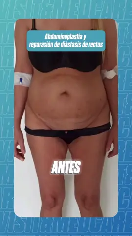 🎥 Abdominoplastia con corrección de diástasis En este video se muestra el procedimiento de una abdominoplastia completa, combinada con la reparación del diástasis de los músculos rectos del abdomen. Esta intervención tiene como objetivo reconstruir la pared abdominal, eliminar el exceso de piel y mejorar la silueta del paciente. El resultado es un abdomen más firme, plano y estéticamente armonioso. 📍Realizado por un equipo especializado en cirugía estética y reconstructiva.