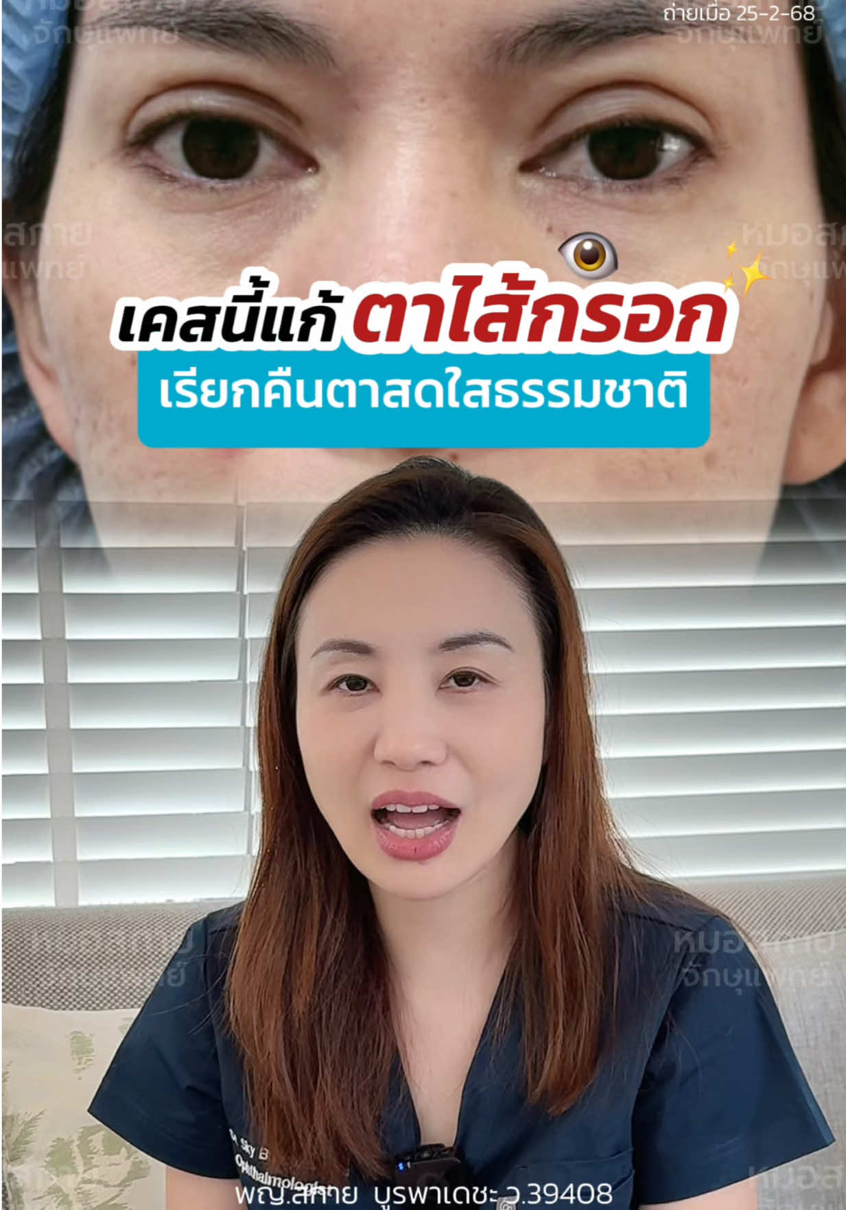 ใครเคยเป็นตาไส้กรอกบ้าง ⁉️ #รีวิวแก้ตาสองชั้น  #แก้ตาสองชั้น  #ตาหอยแครง #ชั้นตาใหญ่  #หมอสกาย #จักษุแพทย์ #หมอตา #สกายคลินิก #ทำตาที่ไหนดี #หนังตาตก  #skyclinic #ศัลยกรรมตา