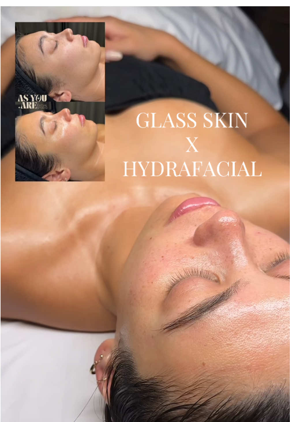 My fav no downtime treatment! #sandiegohydrafacial #hydrafacial #dermaplane #lajollafacialist #lajollacove #sandiegoskin 