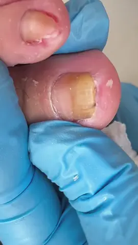 #pedicure #footcare #nailscare #nails#pedicuretools #podologia #relax #feetcare #toenail #toenailremoval #nailfungus #fyp#ingrowntoenail#decompression#foryou