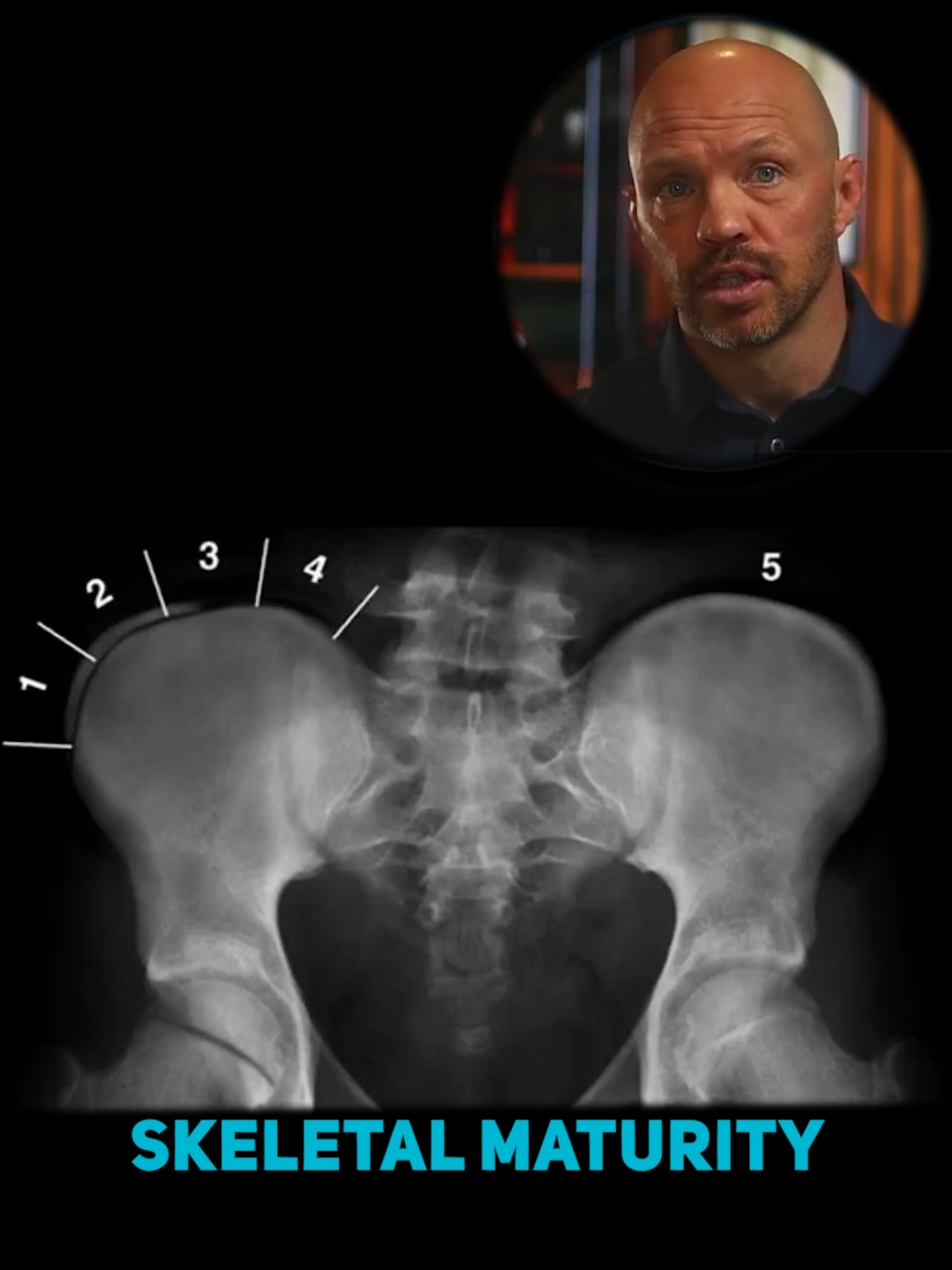 How do we measure bone growth in kids with scoliosis?  ​ The Risser sign helps assess skeletal maturity, guiding treatment decisions!🔢 ​ Ranked from 0 to 5, it tells us how much growth remains.  ​ The tricky part?  ​ Risser 0 and Risser 5 can look similar; additional spinal indicators are considered for accuracy in determining skeletal maturity.🦴 ​ #GrowthPlateAnalysis #BoneAgeAssessment #SpinalGrowth #ScoliosisScreening #RisserStage #HealthyGrowth #ChildrensHealth #SpineDevelopment #PostureCare