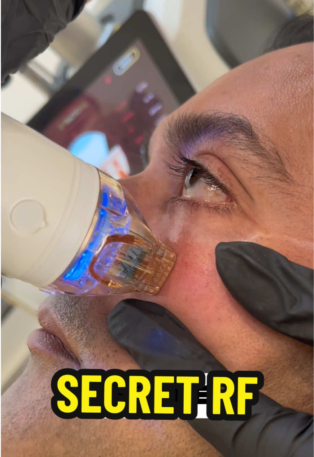 Is this the secret behind your favorite celeb's flawless skin? Secret RF is a game-changing treatment that combines microneedling with radiofrequency to stimulate collagen where aging really begins: deep beneath the surface. BACKWARDS Perfect for: • Fine lines & wrinkles • Skin tightening • Acne scars • Uneven texture & enlarged pores What makes Secret RF unique? It works below the surface without damaging the top laver, making it safe for all skin tones with minimal dowtime. Even after just one session, you can notice: • Smoother texture • A subtle lift around the eyes & jawline • Tighter, more radiant skin Results only get better in the weeks that follow! Book your consultation now at PHI Clinic, Harley Street, London by clicking the link in our profile description #microneedling #celebritytreatment #secretrf #morpheus8 #acne #finelines #wrinkles #skintexture