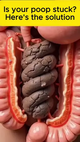 Eliminate Poop Naturally. Follow us for more recipes. . . #detoxing #Recipe #weightlossstory #health #viral #fitnessmotivation #poop #constipation 