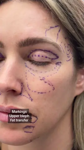 Upper Bleph and Fat Transfer to Lower Eyelid Hollows.  3 month Post-Op.  *Fillers were dissolved prior to procedure. This was done awake in the office under local numbing injections. Consultation Booking: 🔳call/text: (310) 858-8930 🔳email: info@drjalalabadi.com Location: 📍 Beverly Hills, CA . #eyes #holloweyes #fattransfer #blepharoplasty #hoodedeyes #eyemakeup #bleph #hoodedeyesmakeup 