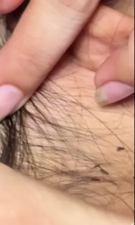 #lice #asmr #liceremoval #kutu #2025 #fast #😱 