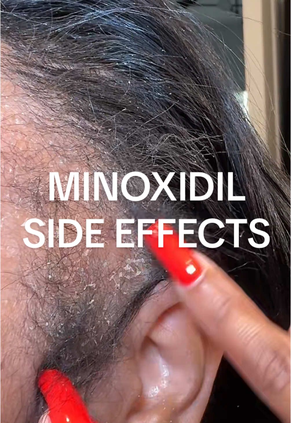 Minoxidil Side Effects: Dry Flaky Scalp  Treatment : Hair Grease  If you use something else for your scalp please share 🤗💕  #minoxidilresult #tractionalopecia #alopecia #minoxidil #fyppppppppppppppppppppppp 