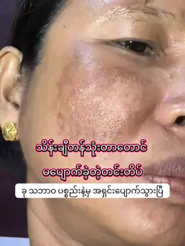 တင်းတိပ်တွေအရှင်းပျောက်သွားပြီ #တင်းတိပ်အမဲစက်ပြောက်ချင်သူများအတွက် #အာမခံတင်းတိပ်ဆေး 