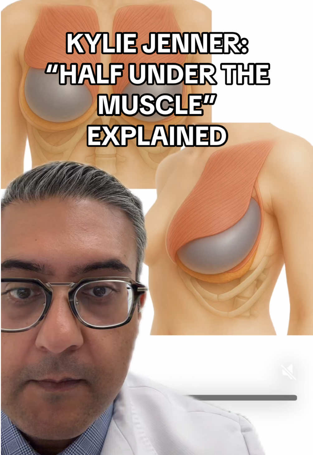 When Kylie Jenner recently shared that she had a “half under the muscle” breast augmentation, she was likely referring to what we call a dual-plane augmentation — a technique I use in the vast majority of my breast augmentation cases. In a dual-plane augmentation, the upper part of the implant is placed beneath the pectoralis major muscle, while the lower part sits under the breast tissue but above the muscle. This hybrid approach allows for a more natural upper breast slope with better soft tissue coverage, while still filling out the lower part of the breast for a perkier, more youthful shape. This technique is ideal for patients with mild sagging or thinner upper pole tissue — and it’s been my go-to method for nearly 15 years. It’s a great example of how breast augmentation isn’t one-size-fits-all. The surgical plan is always tailored to your anatomy and your aesthetic goals. Curious if this technique is right for you? Drop your questions below 👇 #BreastAugmentation #DualPlane #TorontoPlasticSurgery #DrPirani #NaturalResults #KylieJenner #halfunderthemuscle 