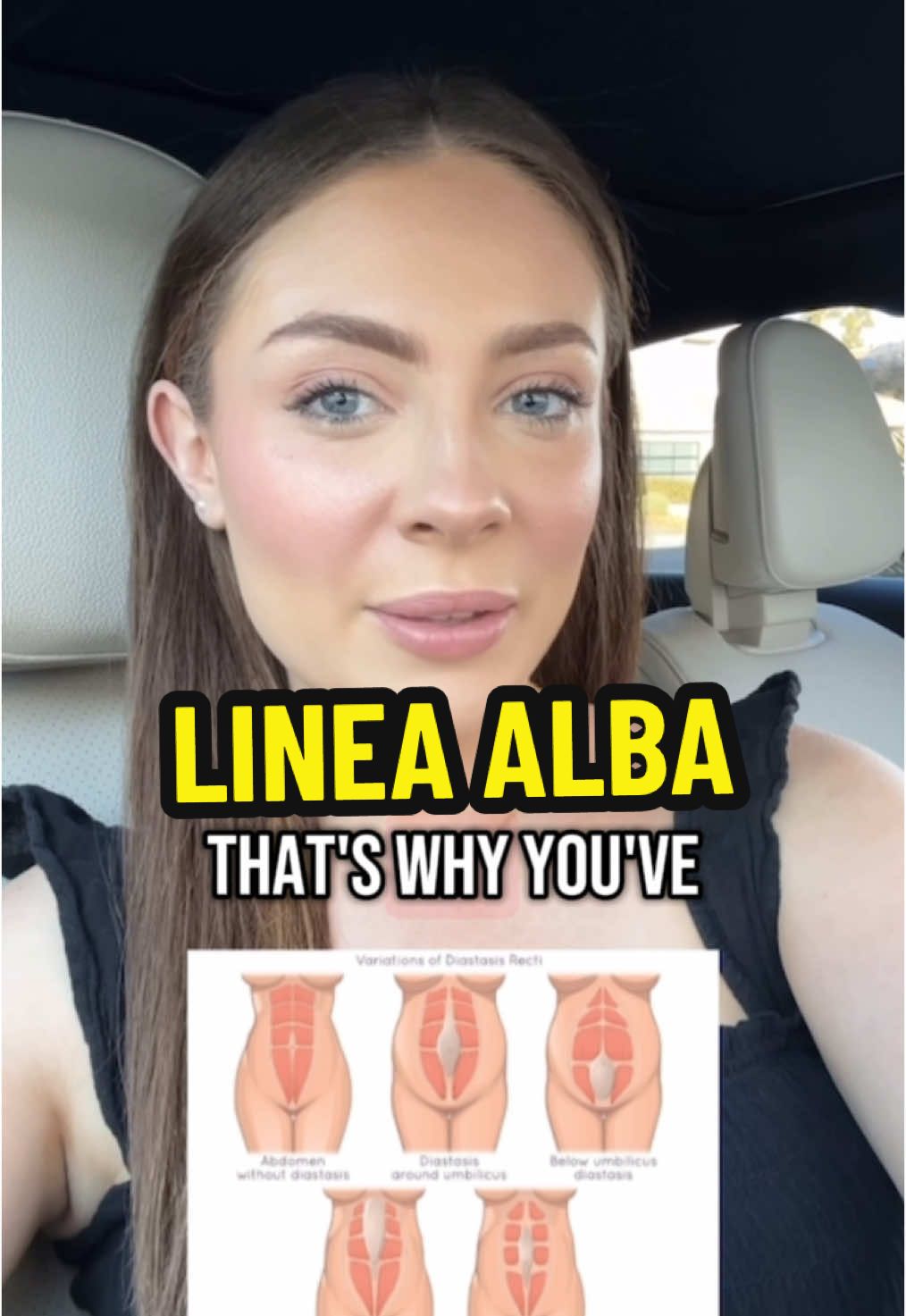 Why do you have a dark line on your belly? That’s your linea alba — a normal response to pregnancy hormones. It’s not a flaw, and it can take months to fade after birth. ☀️ The key is protecting it from the sun — even through clothing. UV rays can set the pigment and slow down fading. If your skin seems slow to recover, that’s okay — but it might help to check. 📩 DM me the word 
