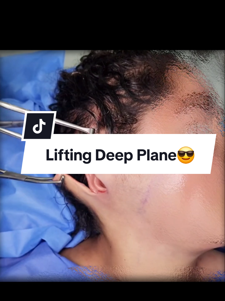 Técnica Deep plane para una apariencia rejuvenecida agenda tu cita o visítanos en📍 San Borja sur 416😎✨️ #lifting #liftingdeepplane #liftingdeplanosprofundos #cirugiafacial #rejuvenecemientofacial #cirujanosperú #liftingfacial #deepplane #liftingfacial #facelifting #lima #perú #drfreddycastillo #fyp #fypシ゚ 